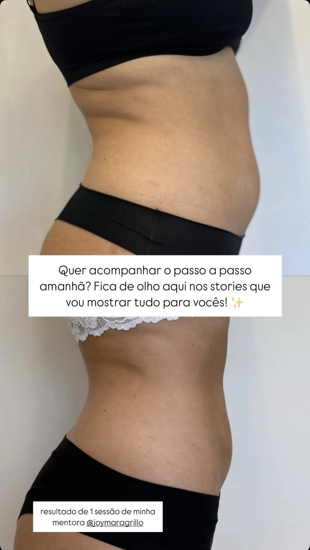 Registro fotográfico de acompanhamento de Endolaser 3
