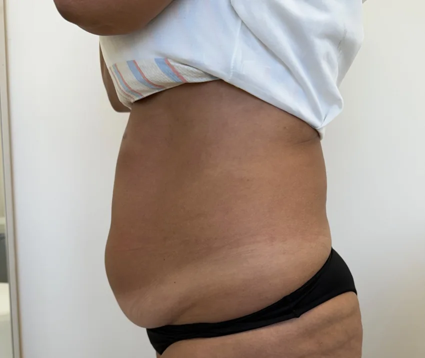 Exemplo real de queixa de contorno abdominal