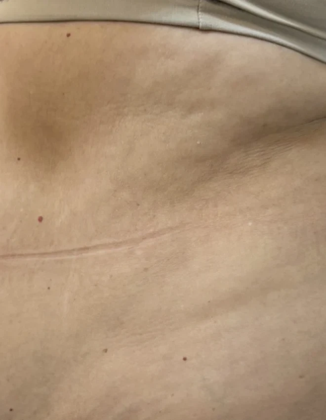 Flacidez da pele na região abdominal