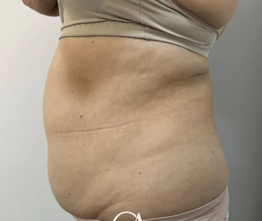 Gordura localizada na região abdominal