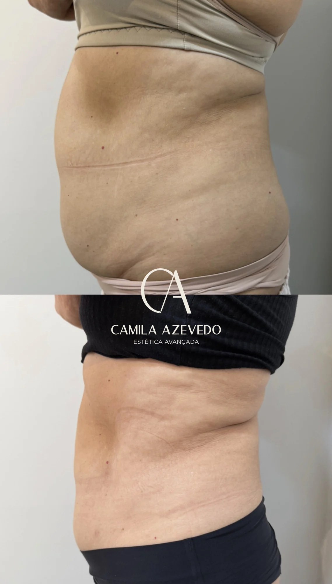 Comparativo de resultado real de Endolaser 1