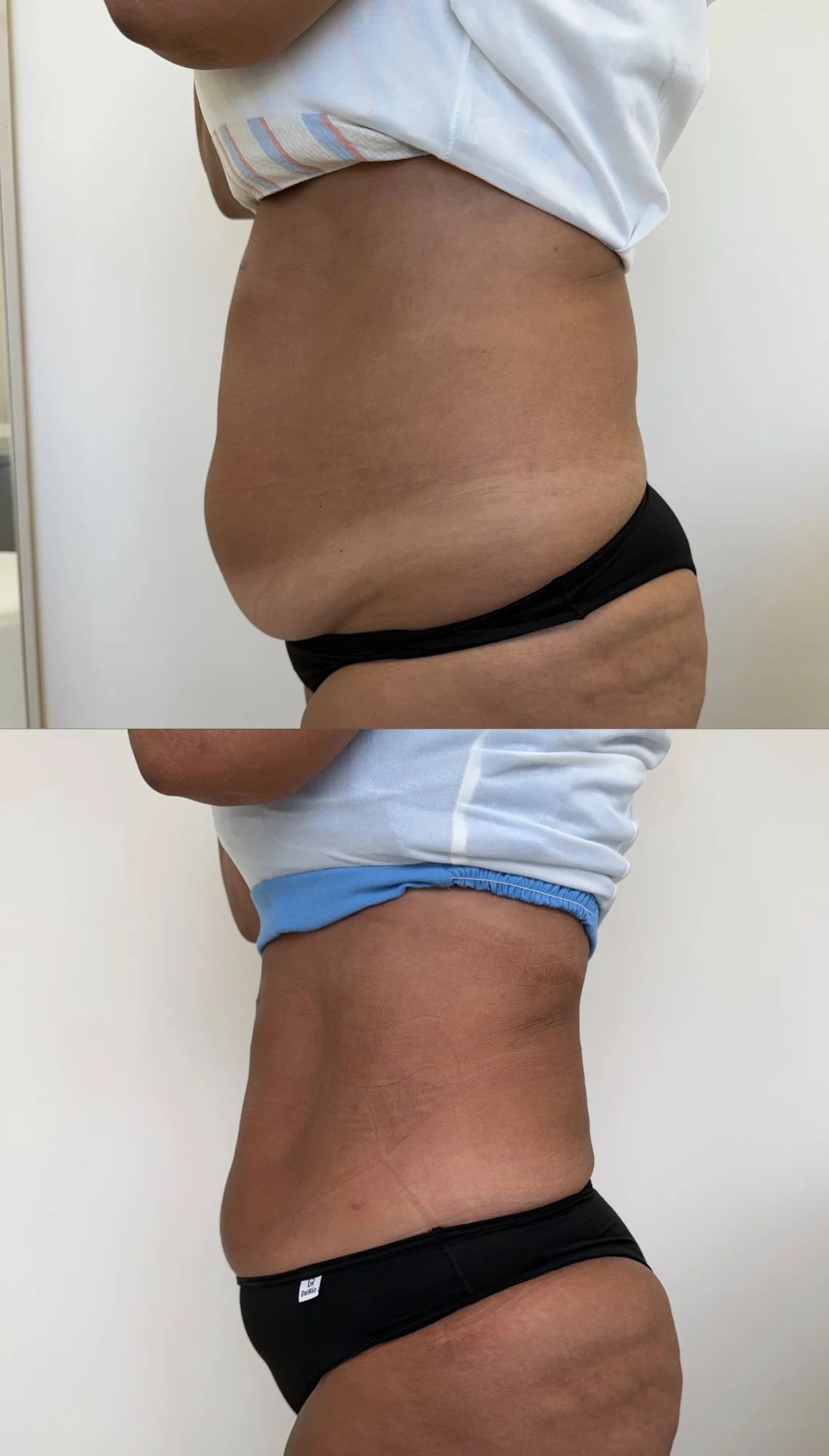 Comparativo de resultado real de Endolaser 3