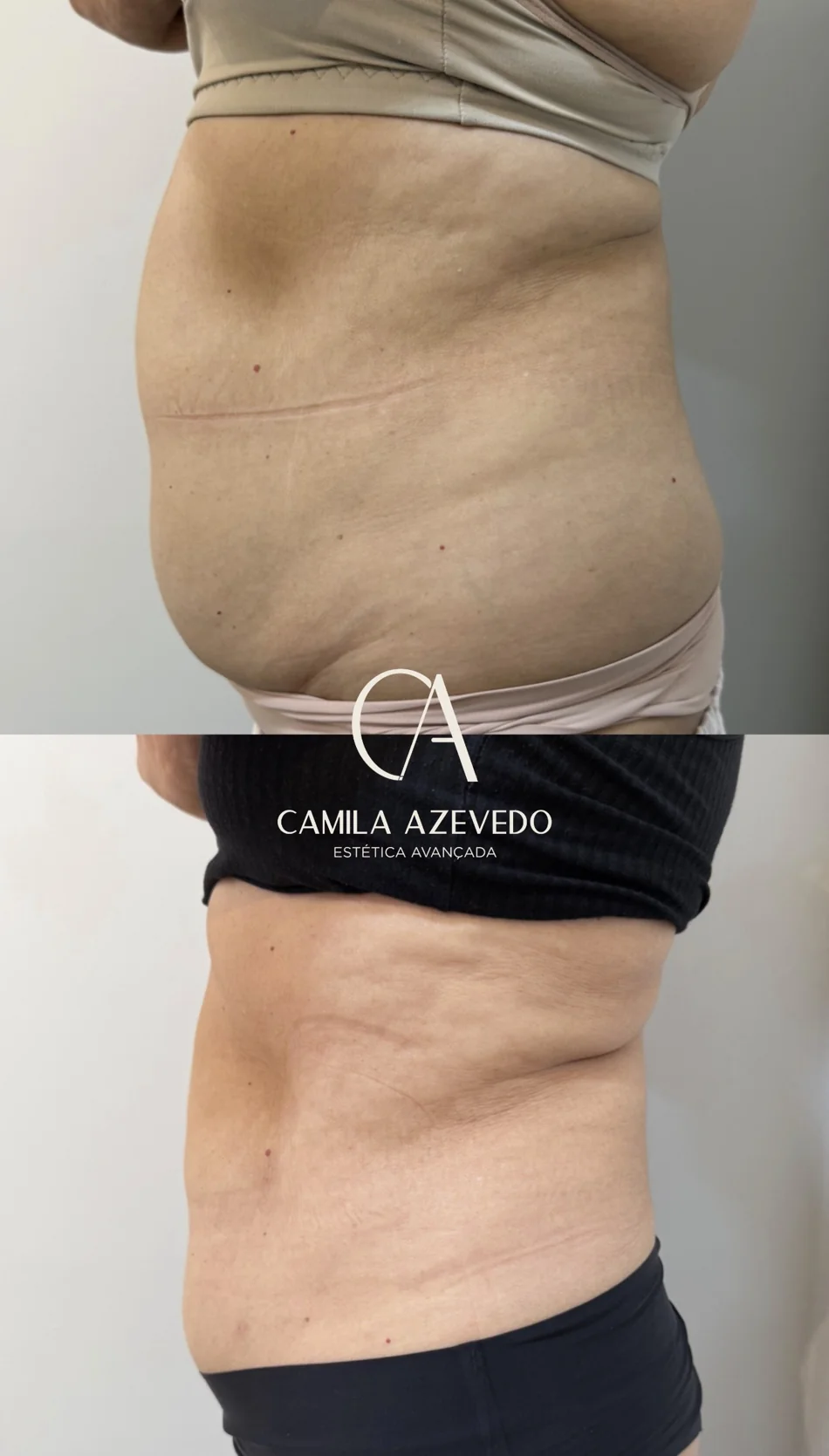Registro real de antes e depois de Endolaser 4